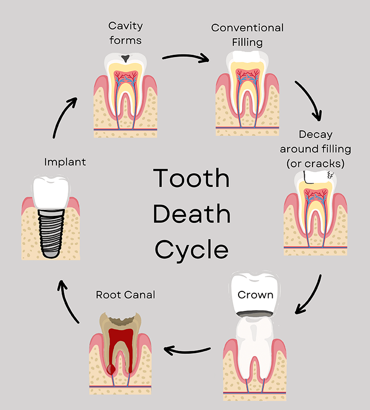 The Ultimate Guide to Cavity Prevention From Our Meridian Dentist ...